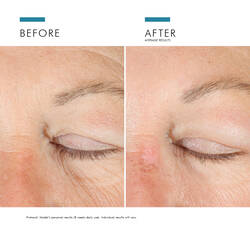 A.G.E. Advanced Eye mot mørke ringer